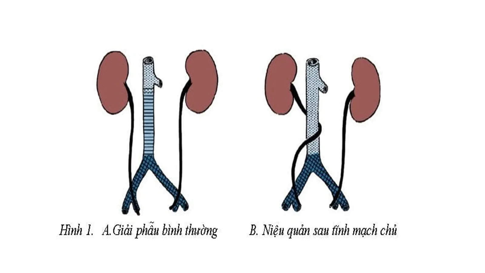 Niệu quản sau tĩnh mạch chủ: Chẩn đoán và điều trị bệnh