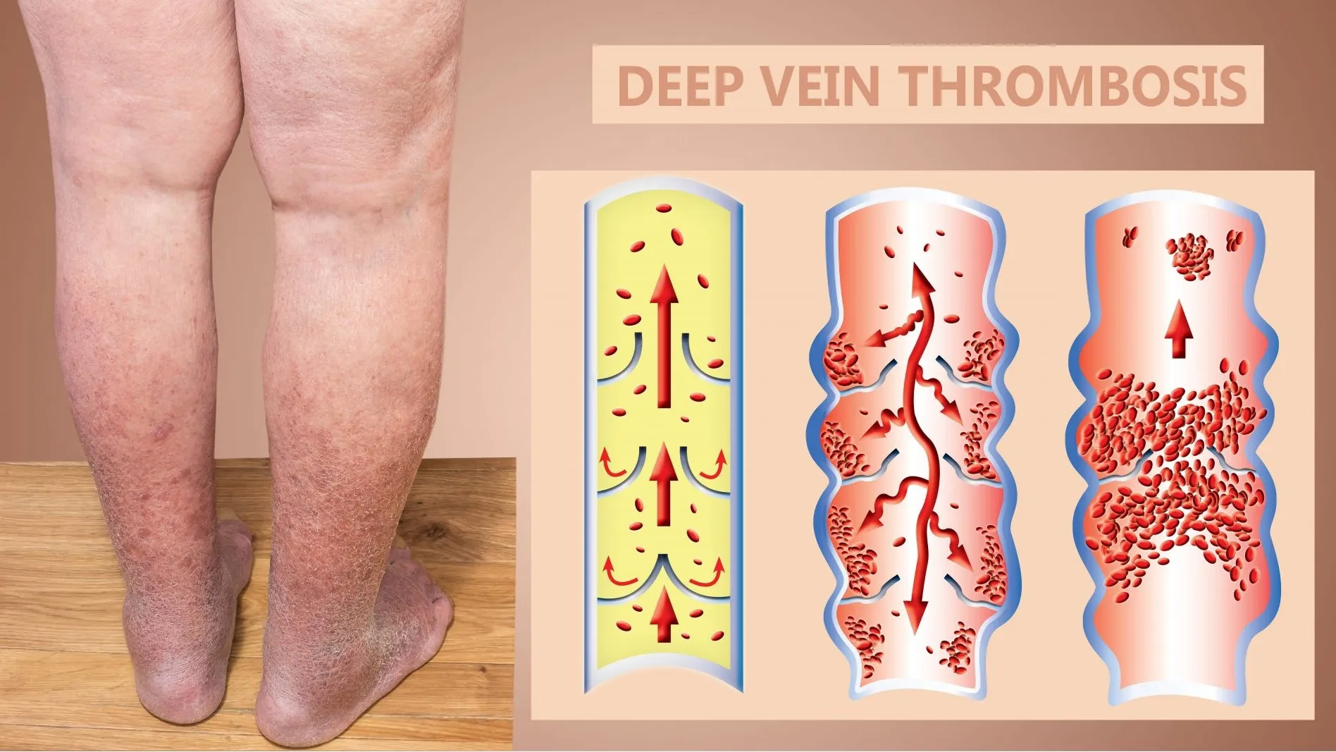 Suy tĩnh mạch mạn ngoại biên: Nguyên nhân, triệu chứng, chẩn đoán và điều trị