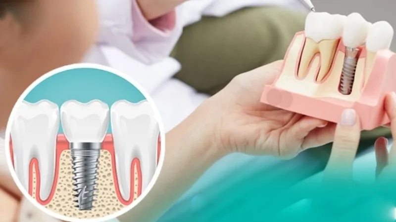 Trồng răng Implant toàn hàm - Giải pháp hiệu quả cho người mất răng